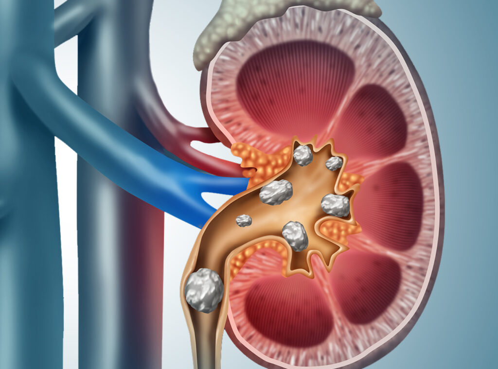 kidney stone remomal