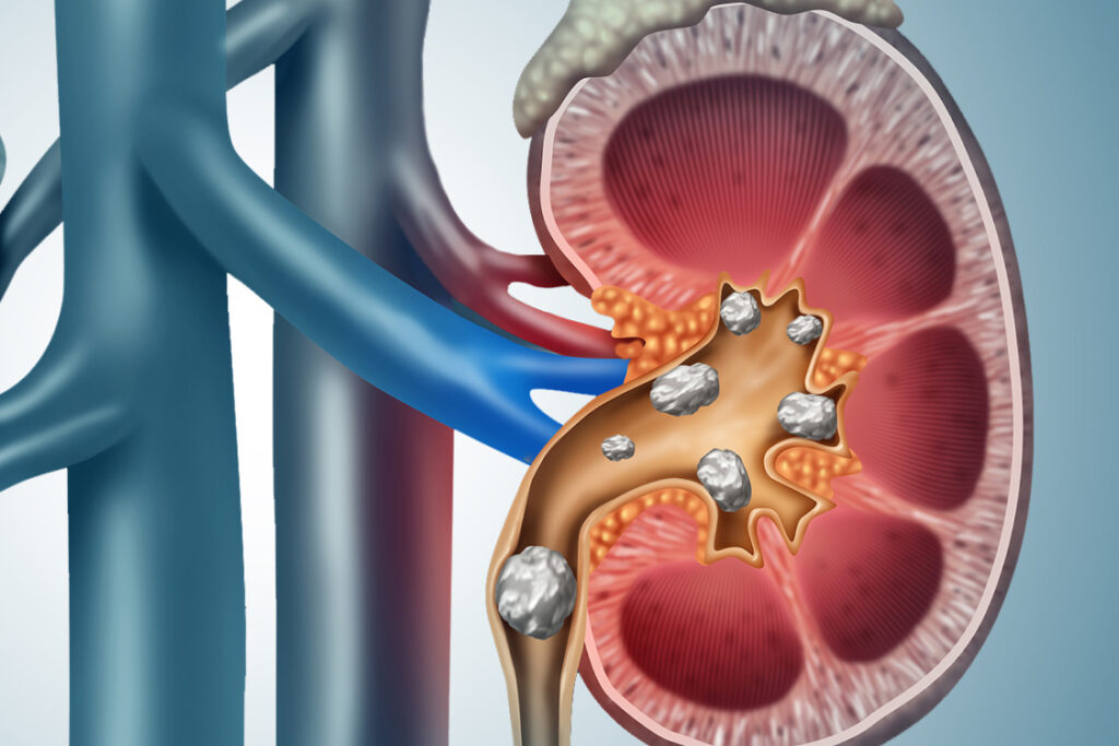 Kidney Stones Removal